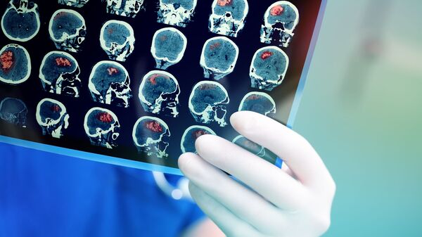 Снимок МРТ мозга пациента  - Sputnik Ўзбекистон