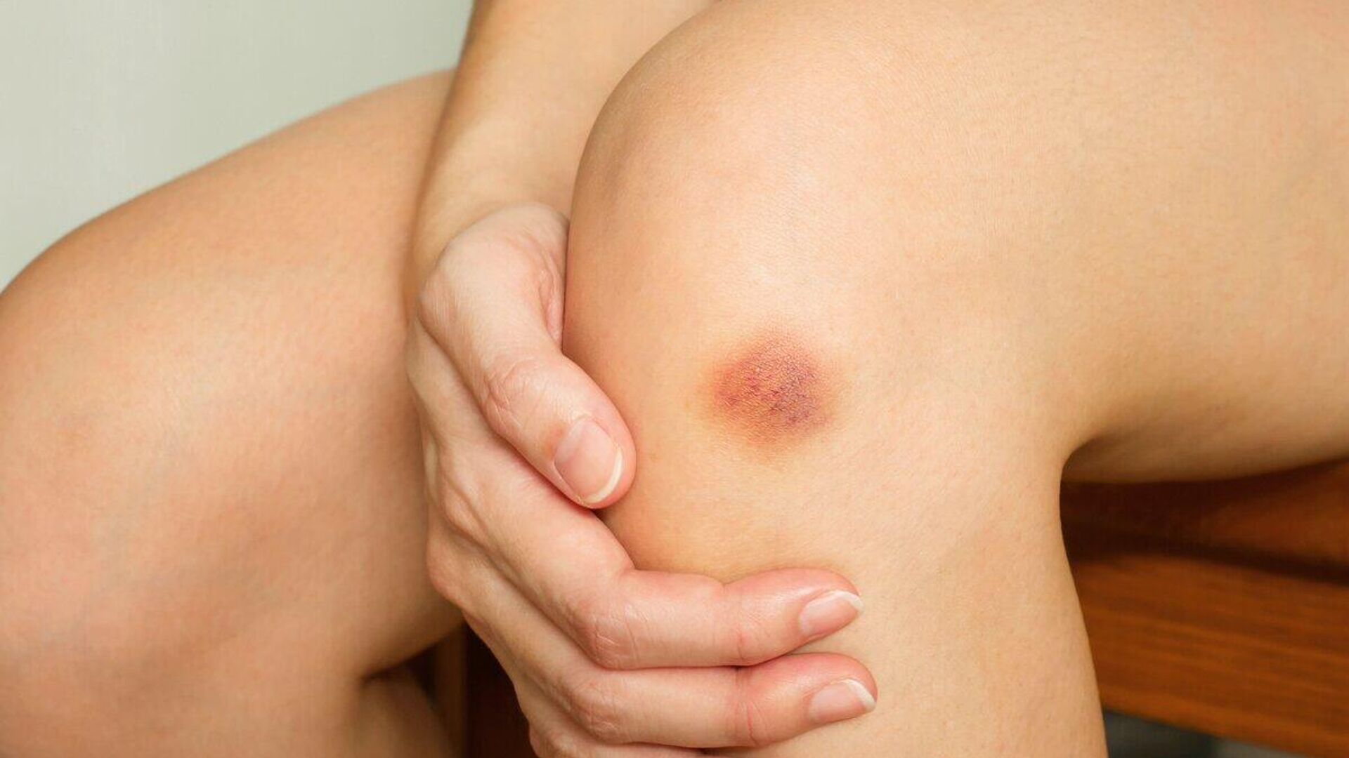 Синяки на ногах без видимых причин Синяки на ногах без видимых причин - Sputnik Узбекистан, 1920, 23.02.2026