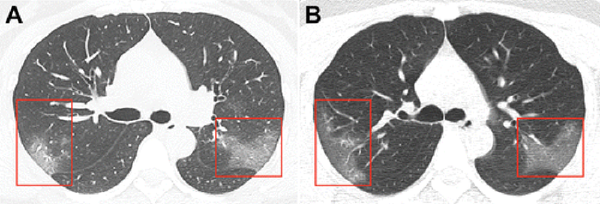 Илк бор коронавирус юққан ўпканинг сурати кўрсатилди - фото Илк бор коронавирус юққан ўпканинг сурати кўрсатилди - фото - Sputnik Ўзбекистон