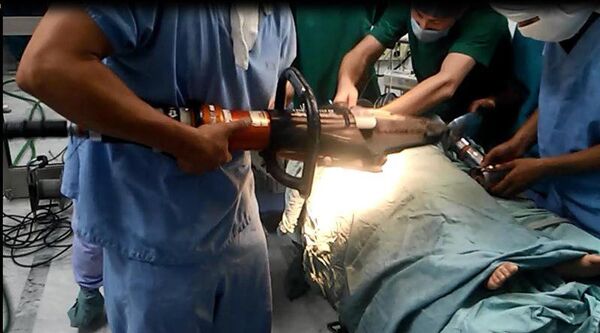 Операция по освобождению руки трехлетней девочки из мясорубки - Sputnik Ўзбекистон